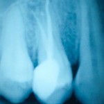 tooth x-ray film