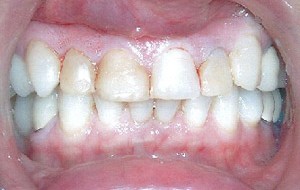 Discolored and decayed composite restorations