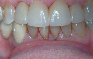 All-porcelain crowns (caps) that are more translucent and life like