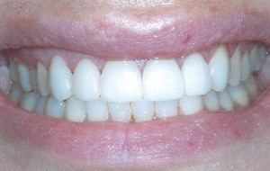 New porcelain veneers