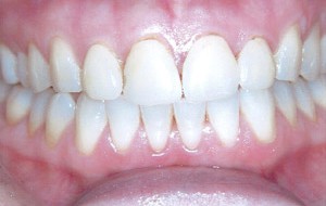 Older chipped and decayed veneers