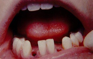 Congenitally missing permanent lateral incisors