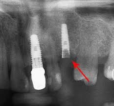 dental implant x ray